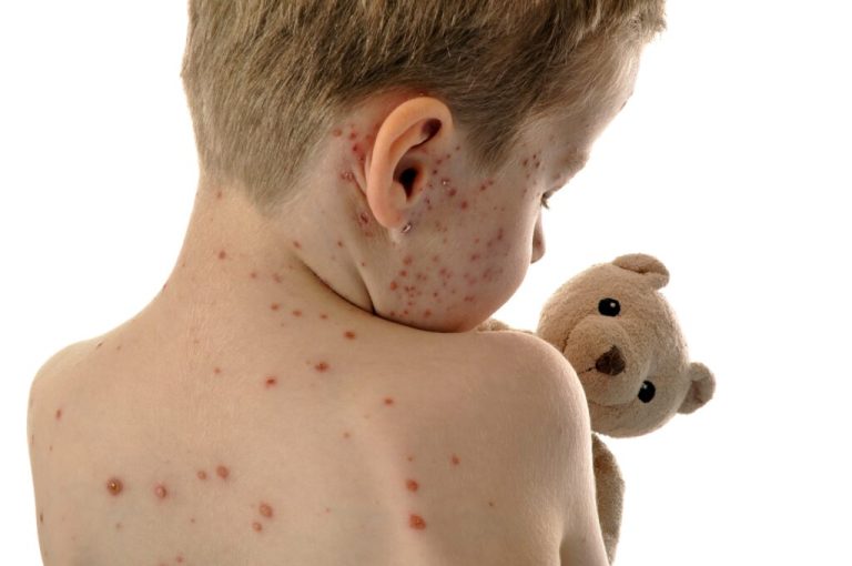 Measles Outbreak In South Carolina